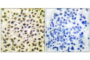 Immunohistochemical analysis of paraffin-embedded human breast carcinoma tissue, using Fos antibody (ABIN5976359). (c-FOS antibody  (N-Term))