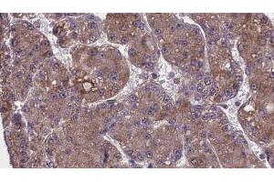 ABIN6274001 at 1/100 staining Human liver cancer tissue by IHC-P. (CD11b antibody  (Internal Region))