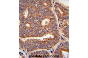 PTPLB Antibody immunohistochemistry analysis in formalin fixed and paraffin embedded human prostate carcinoma followed by peroxidase conjugation of the secondary antibody and DAB staining.