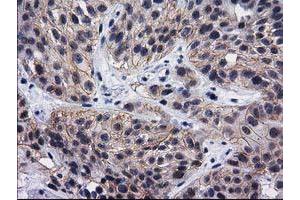 Immunohistochemical staining of paraffin-embedded Carcinoma of Human bladder tissue using anti-DNAJB1 mouse monoclonal antibody. (DNAJB1 antibody)