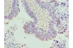 Immunohistochemistry of paraffin-embedded human ovarian cancer using ABIN7173667 at dilution of 1:100 (TUBA3E antibody  (AA 1-250))