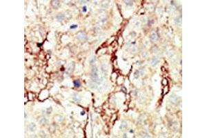 IHC analysis of FFPE human breast carcinoma tissue stained with the FGFR3 antibody (FGFR3 antibody  (AA 776-806))