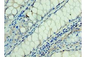 Immunohistochemistry of paraffin-embedded human colon cancer using ABIN7166935 at dilution of 1:100 (RSPO1 antibody  (AA 21-263))