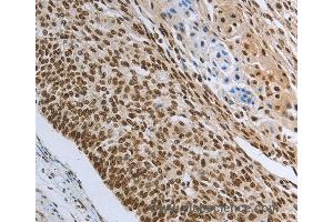 Immunohistochemistry of Human colon cancer using PRMT3 Polyclonal Antibody at dilution of 1:30 (PRMT3 antibody)