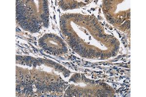 Immunohistochemistry of Human colon cancer using IL2RB Polyclonal Antibody at dilution of 1:60 (IL2 Receptor beta antibody)