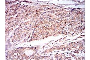Immunohistochemical analysis of paraffin-embedded prostate cancer tissues using CAMK2G mouse mAb with DAB staining. (CAMKII gamma antibody  (AA 322-481))