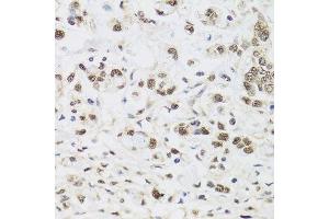 Immunohistochemistry of paraffin-embedded human gastric cancer using PPP1CC antibody. (PPP1CC antibody  (AA 1-323))