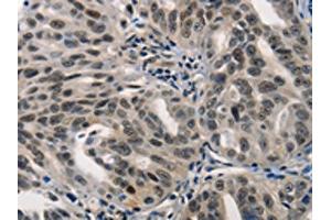 The image on the left is immunohistochemistry of paraffin-embedded Human ovarian cancer tissue using ABIN7190002(BPIFB1 Antibody) at dilution 1/40, on the right is treated with synthetic peptide. (BPIFB1 antibody)