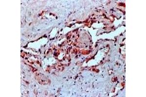 Formalin fixed paraffin embedded human angiosarcoma stained with VEGF antibody