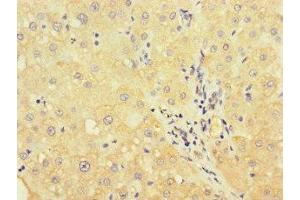 Immunohistochemistry of paraffin-embedded human liver cancer using ABIN7175178 at dilution of 1:100 (UVRAG antibody  (AA 375-425))