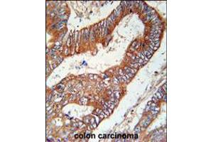 KLHL6 Antibody immunohistochemistry analysis in formalin fixed and paraffin embedded human colon carcinoma followed by peroxidase conjugation of the secondary antibody and DAB staining.