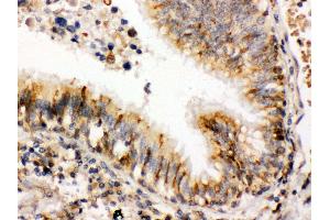 Anti- ERp57 Picoband antibody,IHC(P) IHC(P): Human Lung Cancer Tissue (PDIA3 antibody  (C-Term))