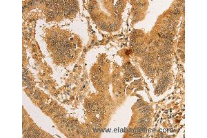 Immunohistochemistry of Human lung cancer using RPL26L1 Polyclonal Antibody at dilution of 1:30 (RPL26L1 antibody)