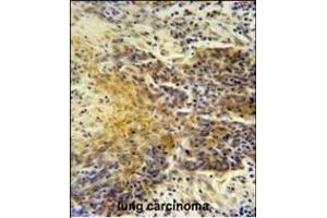 MRPS24 antibody (Center) (ABIN654454 and ABIN2844188) immunohistochemistry analysis in formalin fixed and paraffin embedded human lung carcinoma followed by peroxidase conjugation of the secondary antibody and DAB staining. (MRPS24 antibody  (AA 21-50))