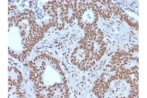 Formalin-fixed, paraffin-embedded human colon carcinoma stained with NRF1 Mouse Monoclonal Antibody (NRF1/2609). (NFE2L1 antibody)