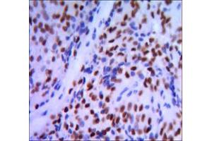 Immunohistochemical analysis of paraffin-embedded pancreatic cancer, using GATA1 mouse mAb with DAB staining. (GATA1 antibody)