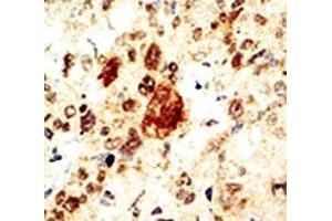 IHC analysis of FFPE human breast carcinoma tissue stained with the EphA1 antibody (EPHA1 antibody  (AA 913-943))