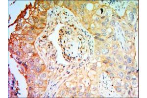 Immunohistochemical analysis of paraffin-embedded lung cancer tissues using PTK7 antibody with DAB staining. (PTK7 antibody)