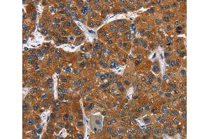 Immunohistochemistry of Human thyroid cancer using CATSPER3 Polyclonal Antibody at dilution of 1:60
