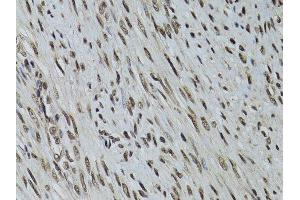 Immunohistochemistry of paraffin-embedded human uterine cancer using STK11 antibody. (LKB1 antibody  (AA 134-433))