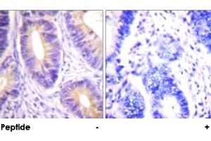 Immunohistochemical analysis of paraffin-embedded human colon carcinoma tissue using CBL polyclonal antibody . (CBL antibody)