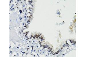 Immunohistochemistry of paraffin-embedded Human lung using Phospho-Stat3(S727) Polyclonal Antibody at dilution of 1:100 (40x lens). (STAT3 antibody  (pSer727))