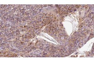 ABIN6273055 at 1/100 staining Human lymph cancer tissue by IHC-P. (MAVS antibody  (C-Term))