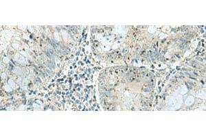 Immunohistochemistry of paraffin-embedded Human colorectal cancer tissue using PAK1IP1 Polyclonal Antibody at dilution of 1:120(x200) (PAK1IP1 antibody)