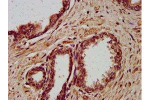 IHC image of ABIN7149771 diluted at 1:400 and staining in paraffin-embedded human prostate cancer performed on a Leica BondTM system. (Desmocollin 3 antibody  (AA 712-896))