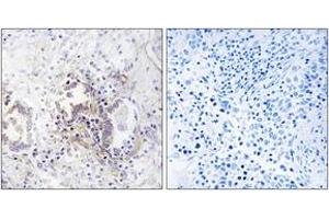 Immunohistochemistry analysis of paraffin-embedded human lung carcinoma tissue, using CHML Antibody. (CHML antibody  (AA 128-177))