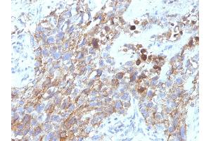 Formalin-fixed, paraffin-embedded human Lung Carcinoma stained with CD56 Mouse Monoclonal Antibody (NCAM1/795). (CD56 antibody)