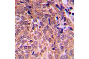 Immunohistochemical analysis of APC staining in human breast cancer formalin fixed paraffin embedded tissue section. (APC antibody  (C-Term))