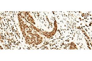 Immunohistochemistry of paraffin-embedded Human esophagus cancer tissue using SNRPB2 Polyclonal Antibody at dilution of 1:75(x200) (SNRPB2 antibody)