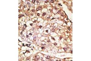 Formalin-fixed and paraffin-embedded human cancer tissue reacted with the primary antibody, which was peroxidase-conjugated to the secondary antibody, followed by AEC staining. (SNCA antibody  (C-Term))