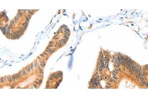 Immunohistochemistry of paraffin-embedded Human colon cancer tissue using ACOX3 Polyclonal Antibody at dilution 1:35 (ACOX3 antibody)