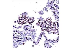 TLR8 Antibody (Center) ((ABIN657933 and ABIN2846877))immunohistochemistry analysis in formalin fixed and paraffin embedded human lung tissue followed by peroxidase conjugation of the secondary antibody and DAB staining.
