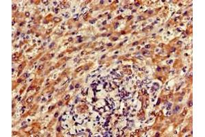 Immunohistochemistry of paraffin-embedded human liver cancer using ABIN7165354 at dilution of 1:100 (FAM111A antibody  (AA 26-179))