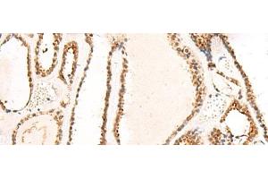 Immunohistochemistry of paraffin-embedded Human thyroid cancer tissue using DCAF10 Polyclonal Antibody at dilution of 1:130(x200) (DCAF10 antibody)
