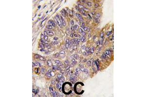 Formalin-fixed and paraffin-embedded human colon carcinoma tissue reacted with RPS6KA1 polyclonal antibody  , which was peroxidase-conjugated to the secondary antibody, followed by DAB staining. (RPS6KA1 antibody  (Ser732))