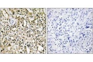 Immunohistochemistry analysis of paraffin-embedded human liver carcinoma tissue, using MYC Antibody.