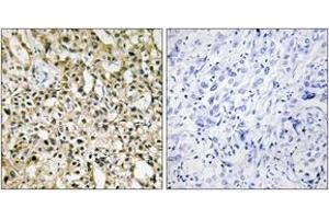 Immunohistochemistry analysis of paraffin-embedded human liver carcinoma tissue, using MYC Antibody. (c-MYC antibody  (AA 386-435))