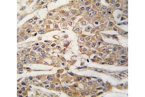 IHC analysis of FFPE human breast carcinoma tissue stained with PKM2 antibody (PKM2 antibody  (AA 460-489))