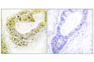 Immunohistochemistry analysis of paraffin-embedded human colon carcinoma tissue using ZNF638 antibody. (ZNF638 antibody  (Internal Region))