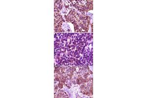 Immunohistochemical analysis of paraffin-embedded human lung carcinoma (A), lymph tissue (B) and skin carcinoma tissue (C), showing membrane localization, using BLK monoclonal antibody, clone 9D10B7H6, 9D10A8F8  with DAB staining. (BLK antibody)