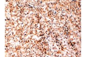ABIN184741 (2 µg/mL) staining of paraffin embedded Human Kidney cancer.