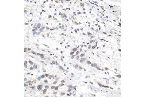 Immunohistochemistry of paraffin-embedded human esophageal cancer using [KO Validated] L3MBTL3 Rabbit pAb (ABIN6132145, ABIN6143061, ABIN6143062 and ABIN6223119) at dilution of 1:50 (40x lens). (L3MBTL3 antibody  (AA 1-230))