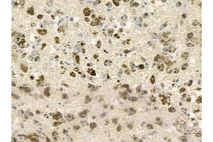 ABIN6260720 and ABIN6276822 at 1/100 staining human melanoma by IHC-P. (CDK7 antibody  (Internal Region))