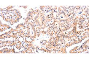 Immunohistochemistry of paraffin-embedded Human thyroid cancer tissue using Ephrin A1 Polyclonal Antibody at dilution 1:37 (Ephrin A1 antibody)