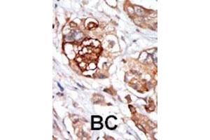 Formalin-fixed and paraffin-embedded human cancer tissue reacted with the primary antibody, which was peroxidase-conjugated to the secondary antibody, followed by DAB staining. (Mps1 antibody  (N-Term))