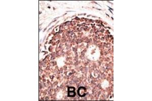 Formalin-fixed and paraffin-embedded human cancer tissue reacted with the primary antibody, which was peroxidase-conjugated to the secondary antibody, followed by DAB staining. (MMP 9 antibody  (C-Term))